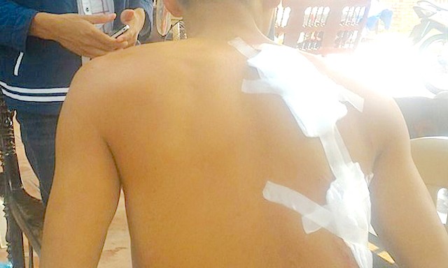 Vác dao chém hàng xóm, 3 người bị thương Anh Tuấn bị 4 vết chém
