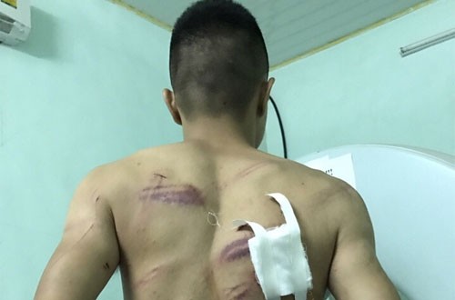 Ba người đàn ông bị truy sát giữa ban ngày Anh Hưng với vết thương trên lưng