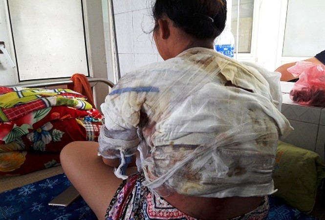 Bắt giam người đàn ông dội nước sôi lên cơ thể vợ Chị Vui bị bỏng nhiều vị trí trên cơ thể