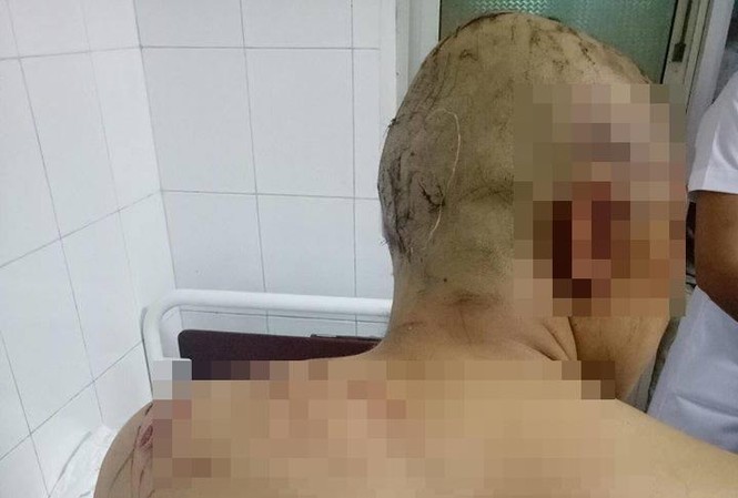 Bị chém hàng chục nhát, thanh niên giả chết thoát thân Cơ thể anh Hùng dày đặc vết thương sau vụ truy sát