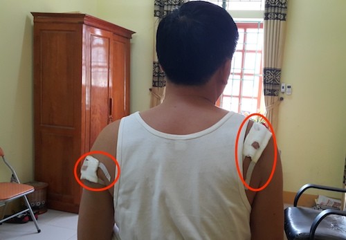 Cựu công an lĩnh 12 tháng tù vì bắn đạn cao su vào chủ tịch xã Vết thương trên người của ông Thanh do ông Thấu gây nên