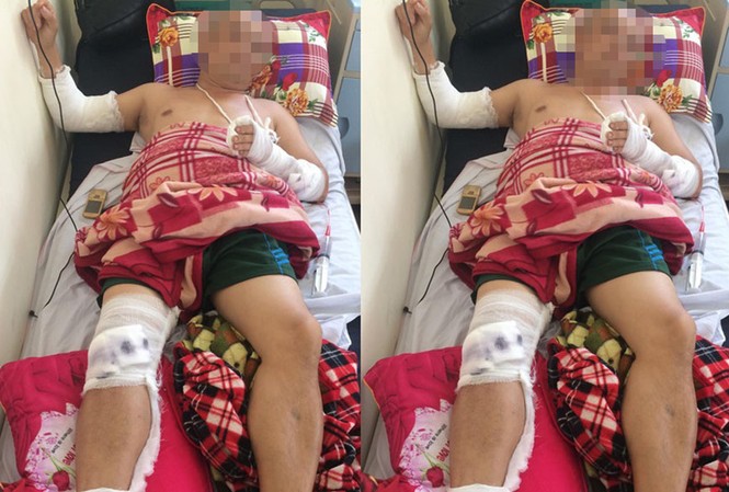 Đi ăn đêm, người đàn ông bị chém gục tại quán Anh Yên bị chém gục tại quán ăn đang được điều trị tại bệnh viện