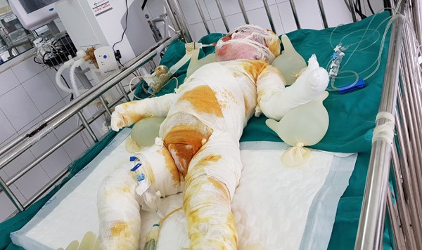 Bé 3 tuổi ngã xuống hố vôi đã qua đời Bé Nhật Linh bị bỏng nặng toàn thân