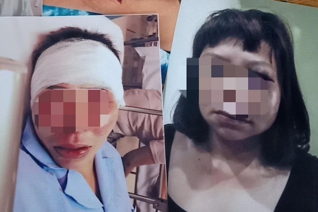Khởi tố người chồng đánh vợ biến dạng mặt vì ghen Chị Hạnh bị chồng bạo hành dã man