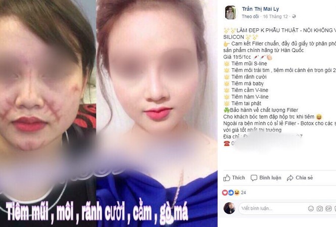 Tiêm filler: Sau công dụng 'thần tiên', làm nhanh giá rẻ là ẩn họa khôn lường! Tiêm filler: Sau công dụng 'thần tiên', làm nhanh giá rẻ là ẩn họa khôn lường!