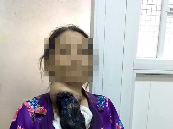 Đắp thuốc ở thầy lang, người phụ nữ vô tình 'nuôi' bướu khổng lồ Đắp thuốc ở thầy lang, người phụ nữ vô tình 'nuôi' bướu khổng lồ