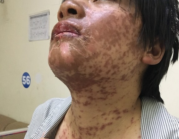 Biến dạng khuôn mặt vì tự ý dùng thuốc đau đầu Biến dạng khuôn mặt vì tự ý dùng thuốc đau đầu