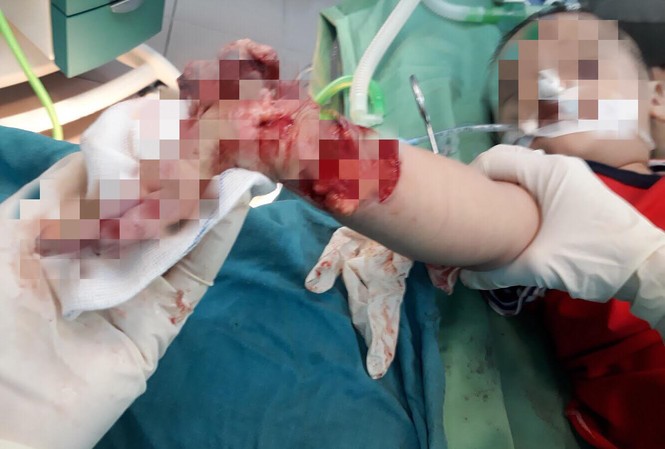 Người lớn lơ là, bé trai 3 tuổi bị máy xay thịt nghiền nát cánh tay Người lớn lơ là, bé trai 3 tuổi bị máy xay thịt nghiền nát cánh tay