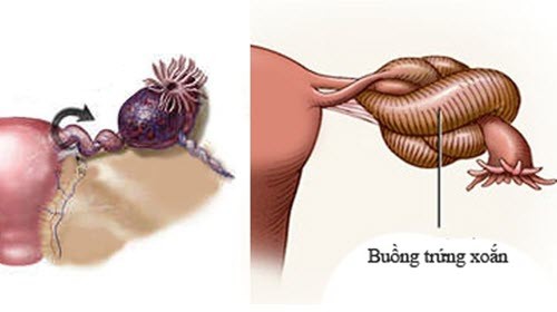 Bé gái 10 tuổi suýt mất buồng trứng vì khối u Bé gái 10 tuổi suýt mất buồng trứng vì khối u