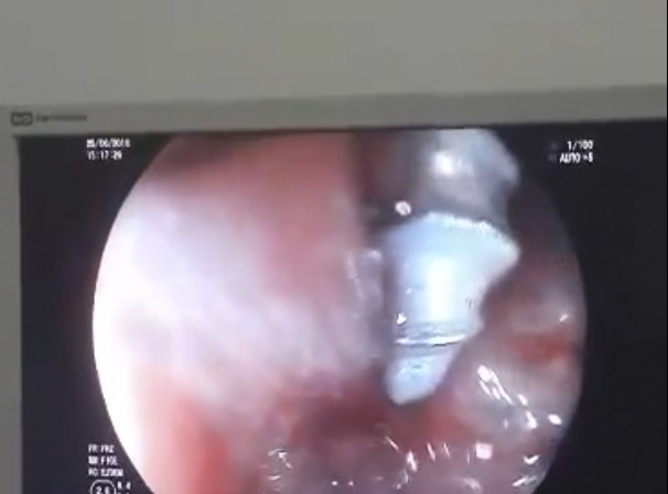 Gắp thành công đinh xoắn ốc ra khỏi dạ dày bé gái 2 tuổi Gắp thành công đinh xoắn ốc ra khỏi dạ dày bé gái 2 tuổi