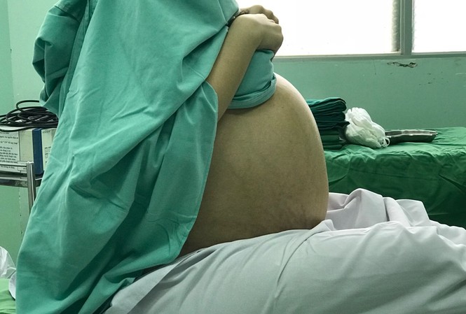 Suýt chết vì lầm tưởng khối u 18 kg là…mỡ bụng Suýt chết vì lầm tưởng khối u 18 kg là…mỡ bụng