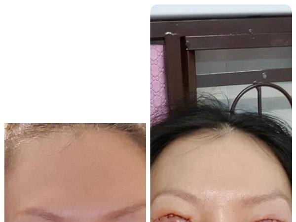 Thẩm mỹ ở cơ sở 'dỏm', đau đớn vì mắt không thể nhắm kín Thẩm mỹ ở cơ sở 'dỏm', đau đớn vì mắt không thể nhắm kín