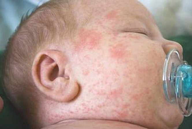 Dịch sởi gia tăng tại TPHCM Dịch sởi gia tăng tại TPHCM