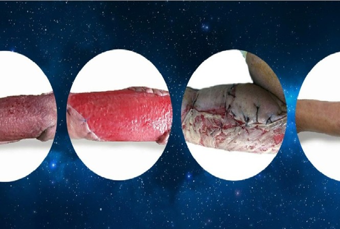 Áp xe nặng do đái tháo đường, cụ ông hồi phục thần kỳ Áp xe nặng do đái tháo đường, cụ ông hồi phục thần kỳ