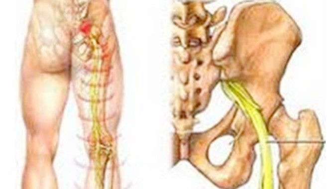 Tê bì chân tay: Cảnh báo nguy hiểm Tê bì chân do chèn ép dây thần kinh tọa.