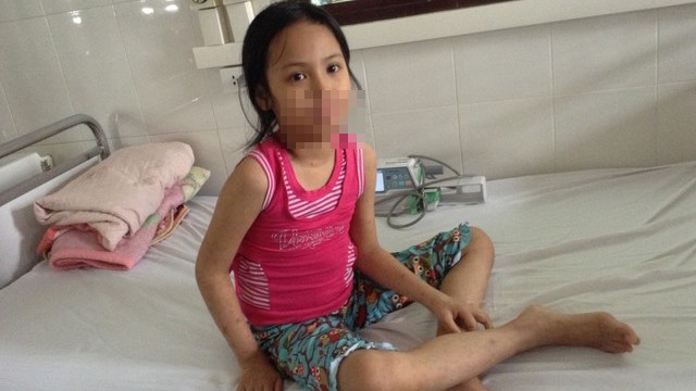 Cứu sống ca đầu tiên mắc sởi biến chứng viêm não, hôn mê sâu
Bệnh nhi trước lúc ra viện. Ảnh: Sức Khỏe Đời Sống