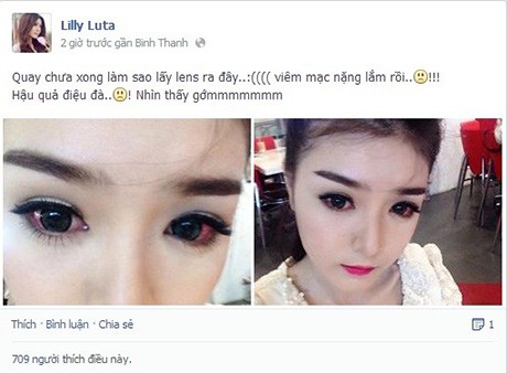 'Hotgirl' gặp họa từ kính áp tròng, giới trẻ giật mình lo lắng 'Hotgirl' gặp họa từ kính áp tròng, giới trẻ giật mình lo lắng