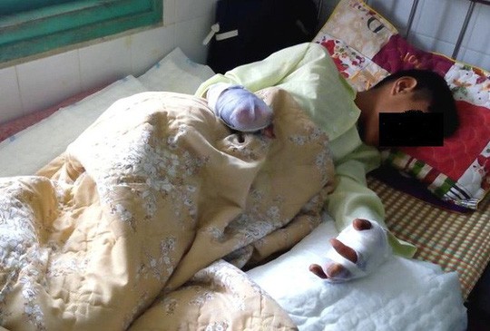 Làm pháo tự chế, học sinh lớp 7 bị dập nát 2 bàn tay Cháu Th. đang điều trị tại bệnh viện
