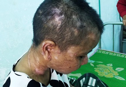 Người tra tấn giúp việc như thời trung cổ có thể chịu án 14 năm tù Hàng trăm vết thương từ đầu xuống chân Y Nhiêu