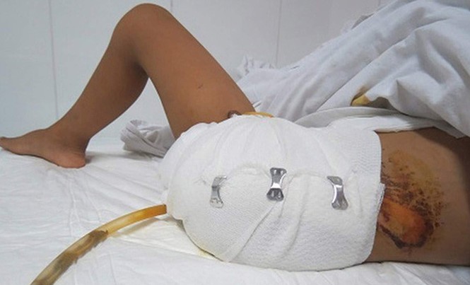 Tự cắt vào cơ thể, bệnh khởi đầu từ stress Bệnh nhân tự cắt chân.