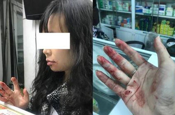 Lái xe Uber đánh khách vì… buồn chuyện gia đình Hình ảnh chị Diệu L. sau khi bị đánh.