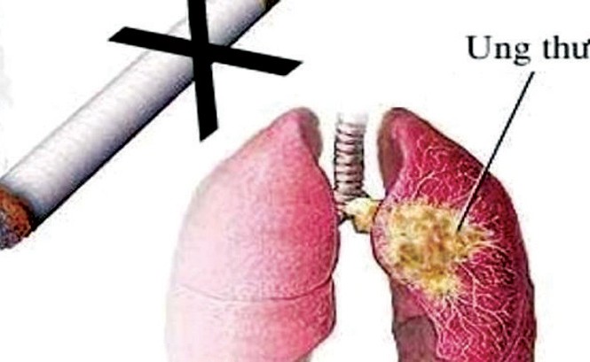 Nguyên nhân hàng đầu mắc các bệnh hô hấp Hút thuốc lá là nguyên nhân của 90% các ca ung thư phổi.