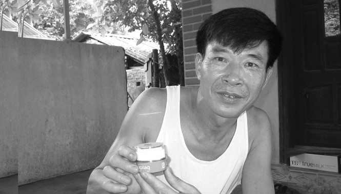 Thoát khỏi 15 năm mất ngủ vì vẩy nến Thoát khỏi 15 năm mất ngủ vì vẩy nến