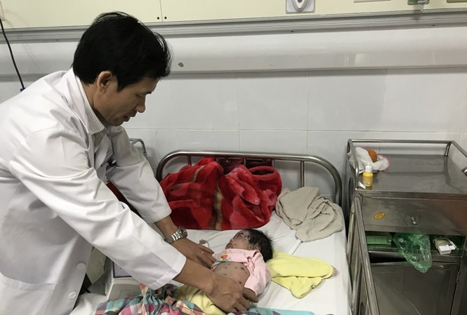 Bệnh thủy đậu vào mùa tấn công trẻ nhỏ Bác sĩ Đỗ Thiện Hải khám cho bệnh nhi G.B. Ảnh: T.Hà.