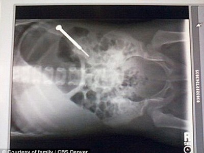 Bé gái 2 tuổi nuốt tua vít 9cm Bé gái 2 tuổi nuốt tua vít 9cm