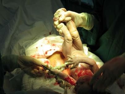 Vì sao bé sơ sinh gãy 2 chân, 1 tay ở bệnh viện? Vì sao bé sơ sinh gãy 2 chân, 1 tay ở bệnh viện?