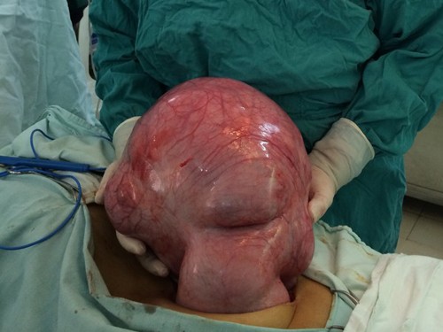Cắt u xơ khổng lồ nặng gần 10kg Cắt u xơ khổng lồ nặng gần 10kg