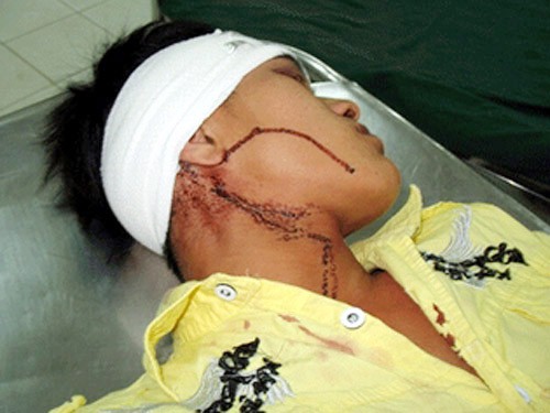 Nghi bị “nhìn đểu”, rút súng bắn người Đứng ra can ngăn nhưng anh Hoàng bị Hùng bắn vào trán gây thương tích - Ảnh có tính chất minh họa