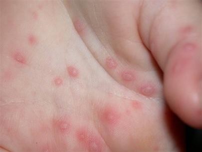Năm người lớn nhiễm virus tay chân miệng Năm người lớn nhiễm virus tay chân miệng