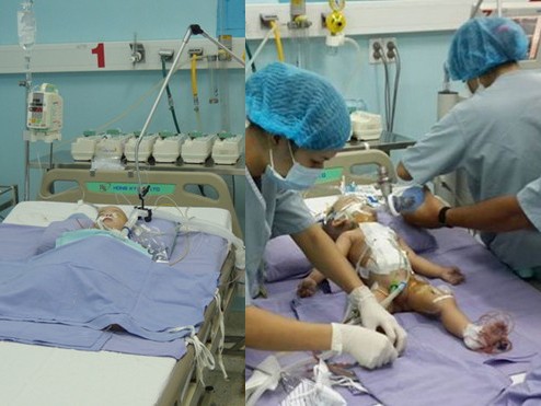 Những điều chưa biết trong ca mổ tách 2 bé dính liền Những điều chưa biết trong ca mổ tách 2 bé dính liền