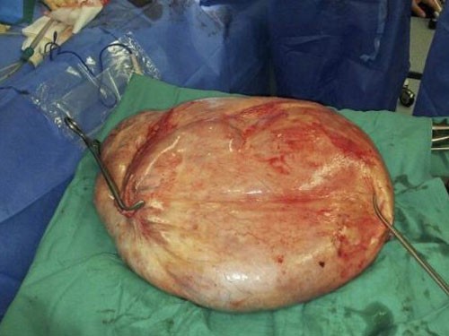 Khó thở vì khối u tử cung nặng…25kg Khó thở vì khối u tử cung nặng…25kg