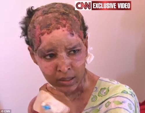 'Ôsin' bị con dâu ông Gaddafi tra tấn dã man Những vết thương chằng chịt trên đầu và người cô Mullah. Cô kể rằng chính Aline Skaf, con dâu của ông Gaddafi, đã tra tấn cô.