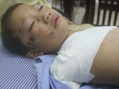 Bé 5 tuổi bị gấu nuôi cắn nát 2 tay Bé 5 tuổi bị gấu nuôi cắn nát 2 tay