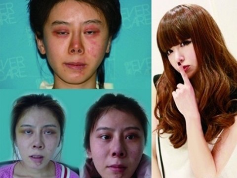 Cô gái đang xinh hóa xấu tệ vì 9 lần phẫu thuật Cô gái đang xinh hóa xấu tệ vì 9 lần phẫu thuật