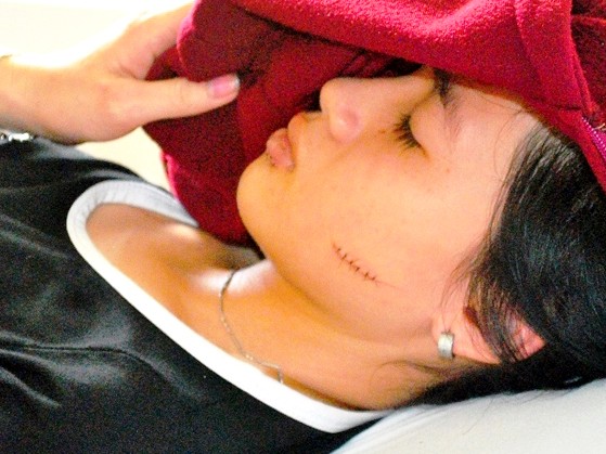 Khởi tố vụ án rạch mặt nữ sinh lớp 12 Nữ sinh với vết rạch dài trên mặt