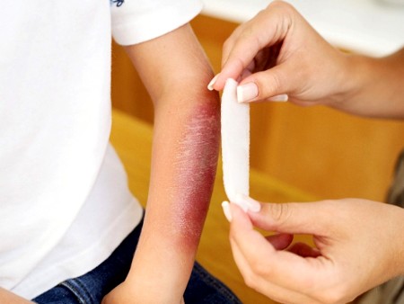 Những lưu ý khi chăm trẻ bị bỏng Những lưu ý khi chăm trẻ bị bỏng