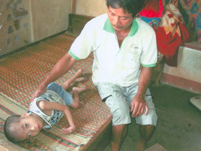 Cháu bé nhiễm chất độc da cam cần giúp đỡ Cháu bé nhiễm chất độc da cam cần giúp đỡ