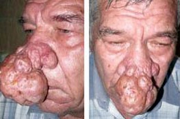 Nga: Người đàn ông mắc bệnh Mũi Voi Nga: Người đàn ông mắc bệnh Mũi Voi