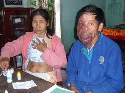 Người có khuôn mặt dị tật cần giúp đỡ Người có khuôn mặt dị tật cần giúp đỡ