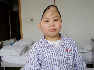 Phẫu thuật thành công cho cậu bé 'nửa đầu' Phẫu thuật thành công cho cậu bé 'nửa đầu'