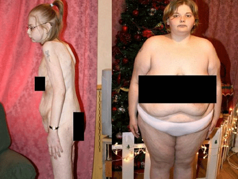 Giảm 170 kg, thiếu nữ suýt mất mạng Giảm 170 kg, thiếu nữ suýt mất mạng