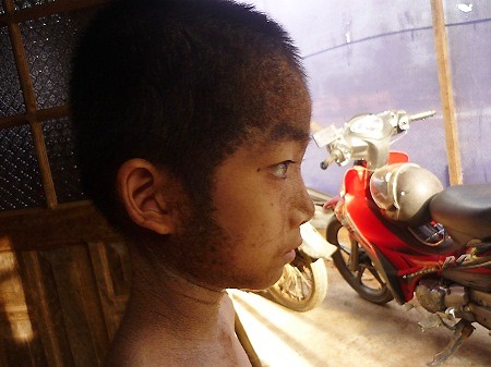Bé trai 'tí hon' mọc sừng khắp người Bé trai 'tí hon' mọc sừng khắp người