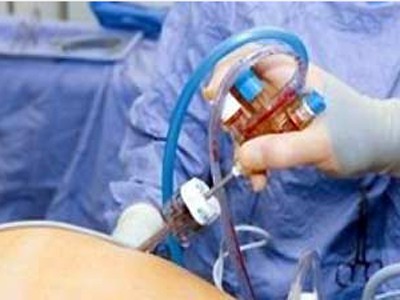 Bọt biển nằm trong bụng suốt 15 năm Bọt biển nằm trong bụng suốt 15 năm