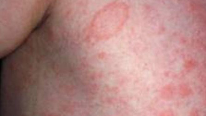 Điều trị bệnh vẩy da- Đừng quên các kem dược liệu bôi ngoài Làn da của bệnh nhân vẩy phấn hồng