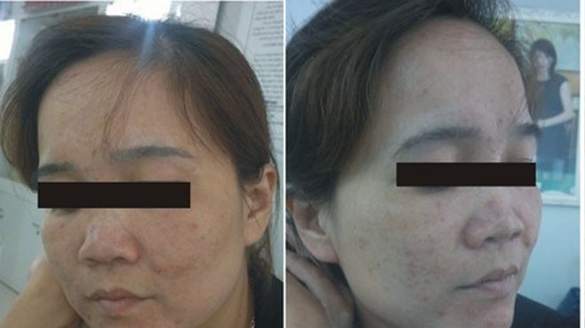 Teo da vì dùng kem mủ trôm làm đẹp Chị Hoàng Thị D. trị nám, làm trắng da bằng mủ trôm gây nên bệnh viêm da cấp tính