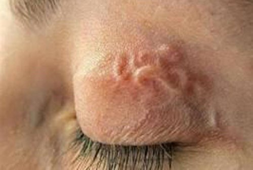 Sự thật nguy hiểm khi ăn thịt chó Ấu trùng ký sinh di chuyển dưới mí mắt trên khi ăn thịt chó.